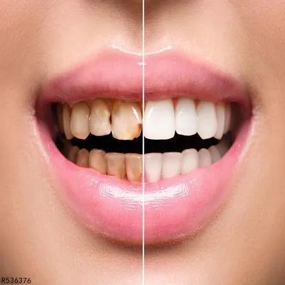 牙龈炎如何治疗 了解牙龈炎的3个治疗方案