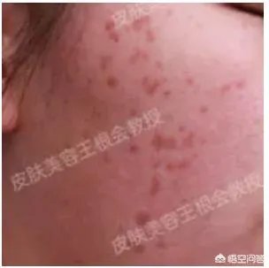 如何判断是不是得了扁平疣?