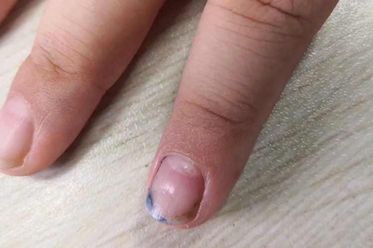 手上汗疱疹图片