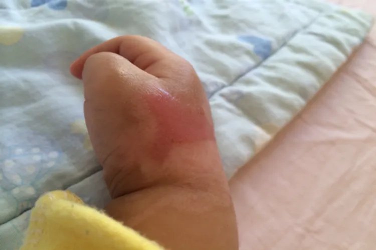 烧伤程度怎么划分标准图片