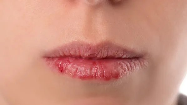 唇炎怎么治疗