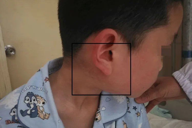 腮腺炎图