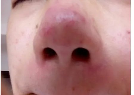 酒糟鼻初期图片是什么样的