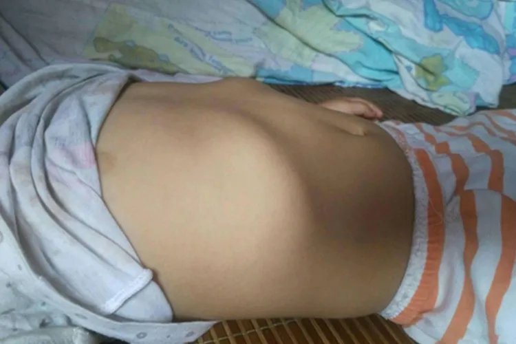 佝偻病的图片