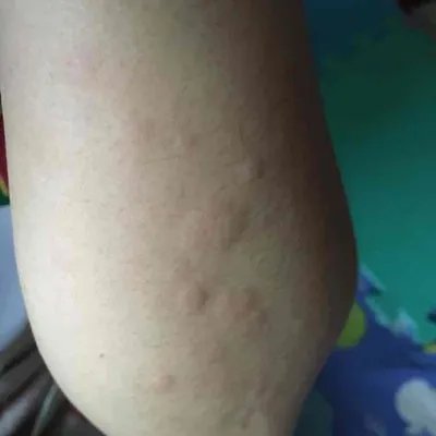 麻风病的症状图片