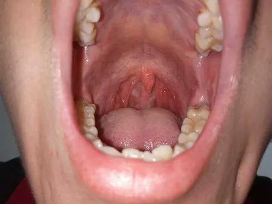 舌癌的早期症状?