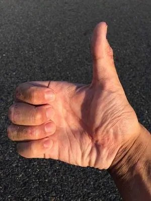 风湿和类风湿怎么得的