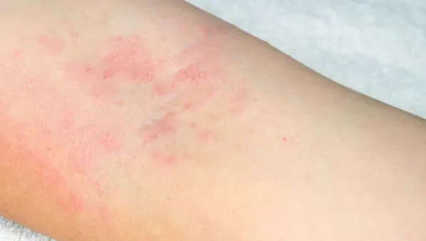 丹毒怎么治疗