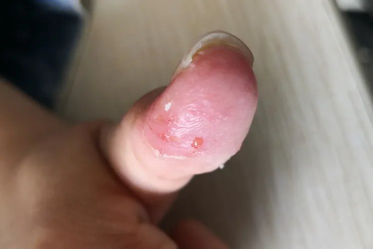 手上汗疱疹图片