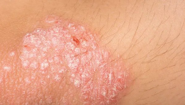 体癣怎么治疗