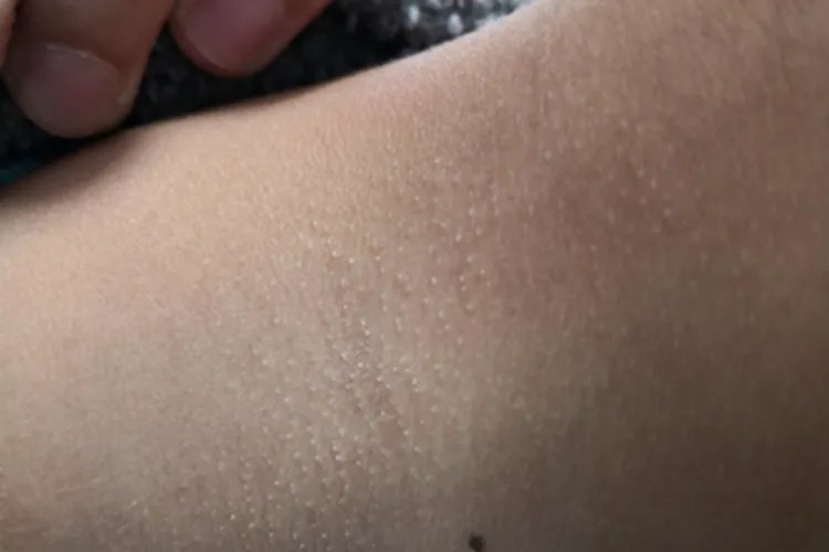 光泽苔藓侧颈症状图片